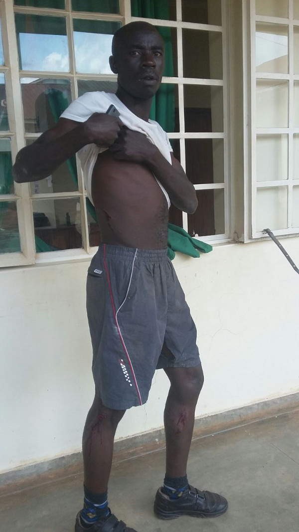 Christopher Kisembo shows injuries sustained as a result of the attack.